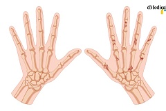 El estudio PerfIL-17 demuestra que ixekizumab (Taltz®), de Lilly, es un inhibidor de IL-17 con alta persistencia, del 86,4% a 1 año en pacientes con artritis psoriásica